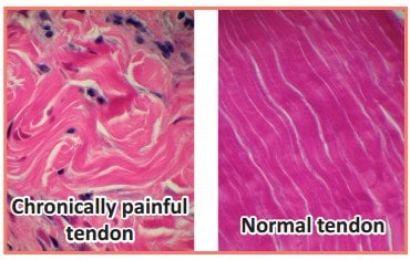 tendon collagen